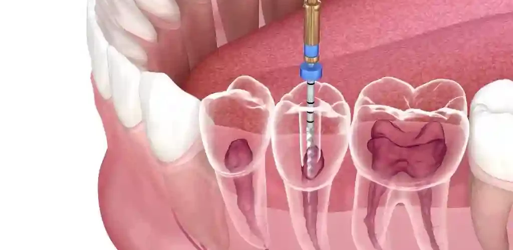 root canal treatment